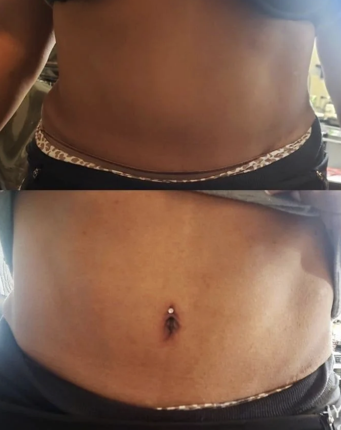 Two close-up shots of a person's midriff showing weight loss progress from before (top) to after (bottom)