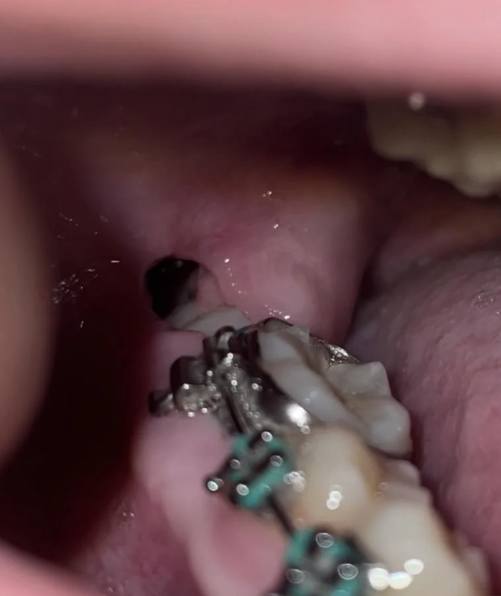 Close-up of a person's mouth, showing teeth with braces and a small inflamed area on the gum