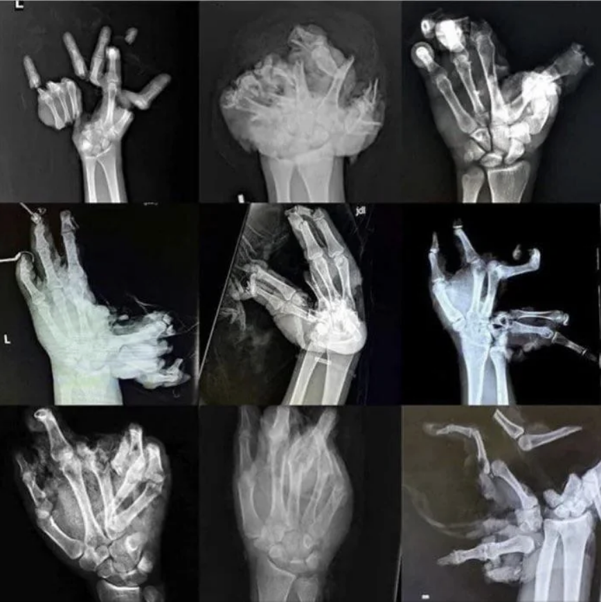 Nine X-ray images of hands in various stages of healing and reconstruction, showing different bone fractures and medical treatments
