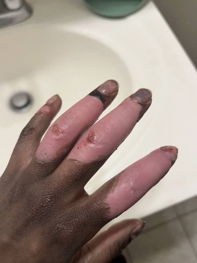 A close-up of a hand showing multiple burn injuries on the fingers, some of which are covered in scabs and discoloration
