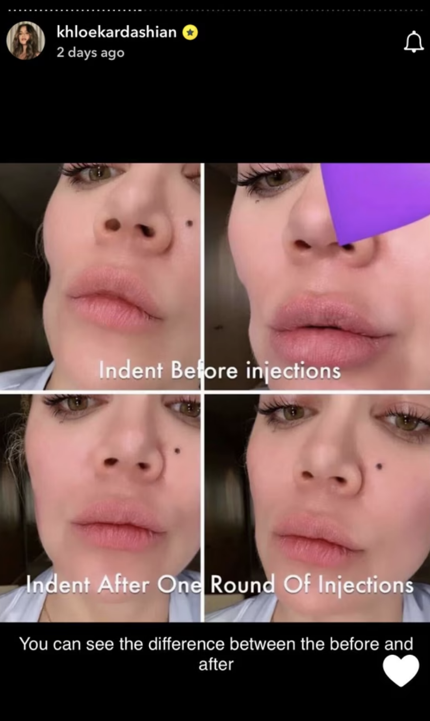 Close-up of Khloe Kardashian&#x27;s face in before-and-after images of cosmetic injections, showing changes to face indentations