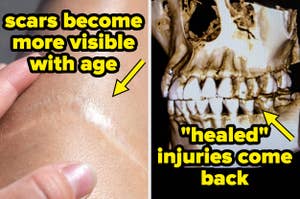A close-up of a scar on skin with text "scars become more visible with age," and an X-ray of a skull with text " 'healed' injuries come back."