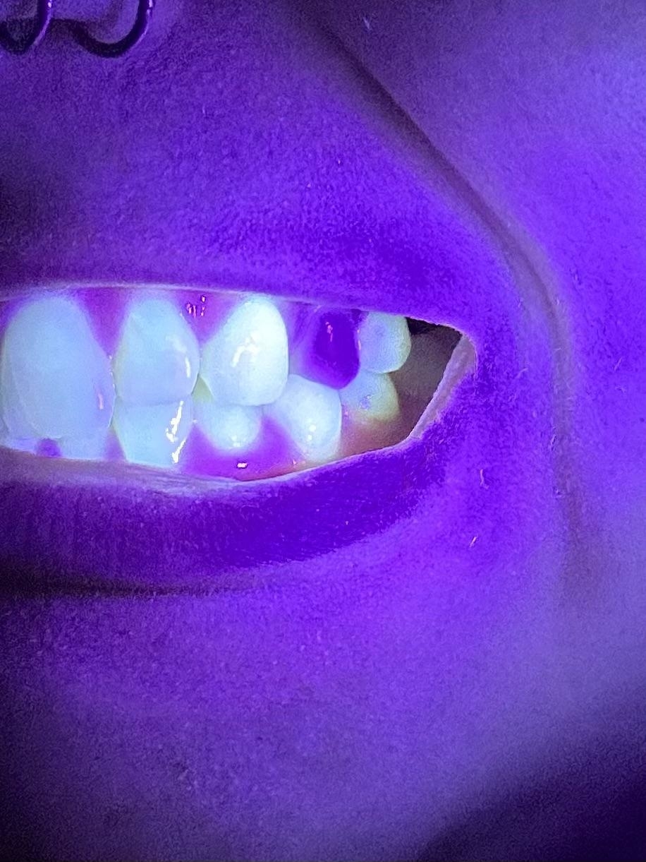 Close-up of teeth under UV light, showing fluorescence