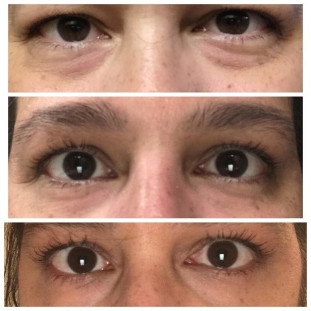 Close-up representation  showing eyes earlier  and aft  utilizing an oculus  cream