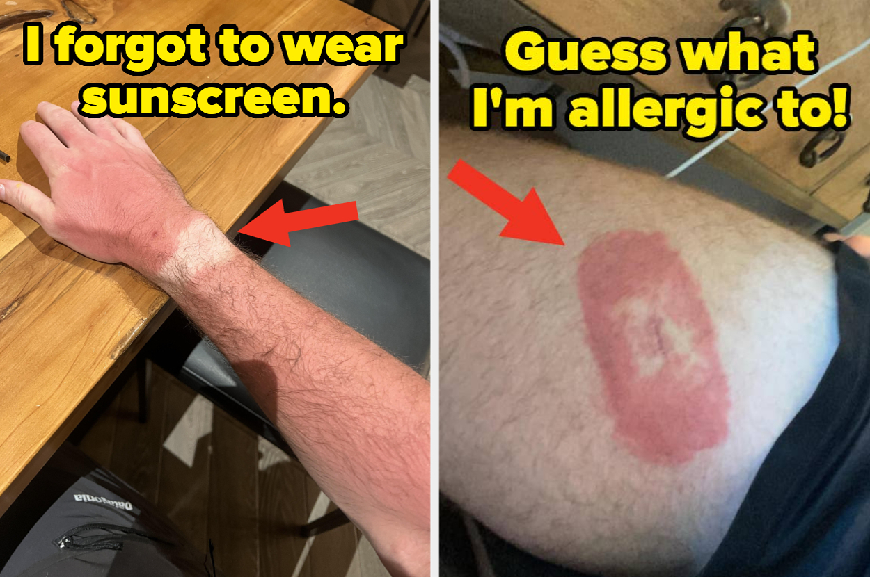 Side-by-side images: left shows a sunburned arm with watch tan line; right shows a red, irritated patch on a person's leg. Text: "I forgot to wear sunscreen. Guess what I'm allergic to!"