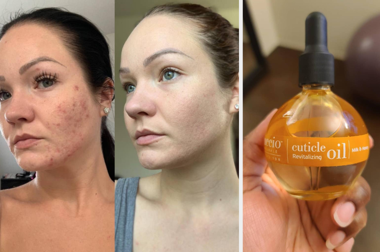 A person's skin before and after skincare treatment, holding a bottle of revitalizing cuticle oil