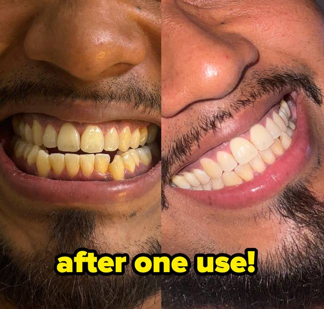 Before and after images showing teeth whitening results. The left side displays yellowed teeth, while the right side shows visibly whiter teeth