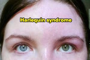 Close-up of a person's face with different eye colors and text "Harlequin syndrome" above their eyes