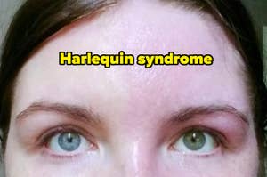 Close-up of a person's face with different eye colors and text "Harlequin syndrome" above their eyes