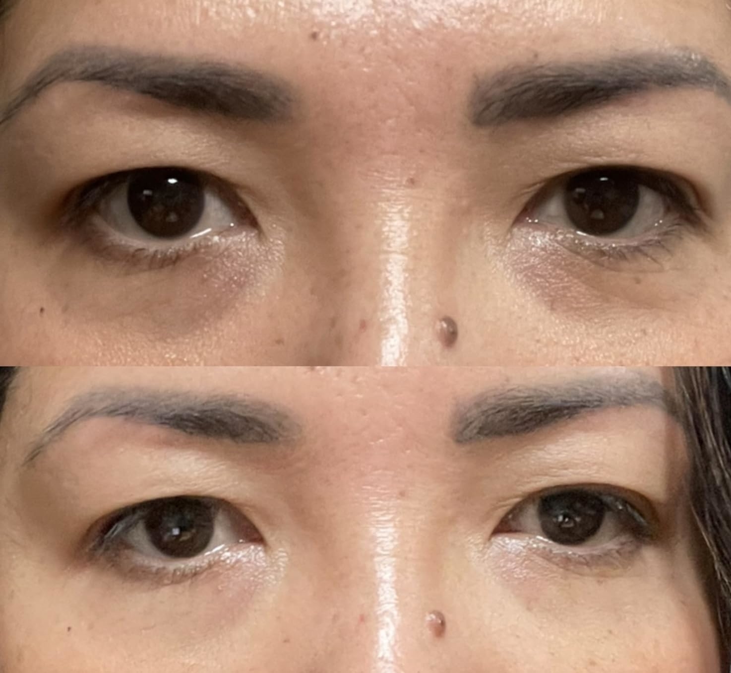 Close-up of a woman’s eyes before and after using an eyelid tape product, showing a lifted appearance in the lower image