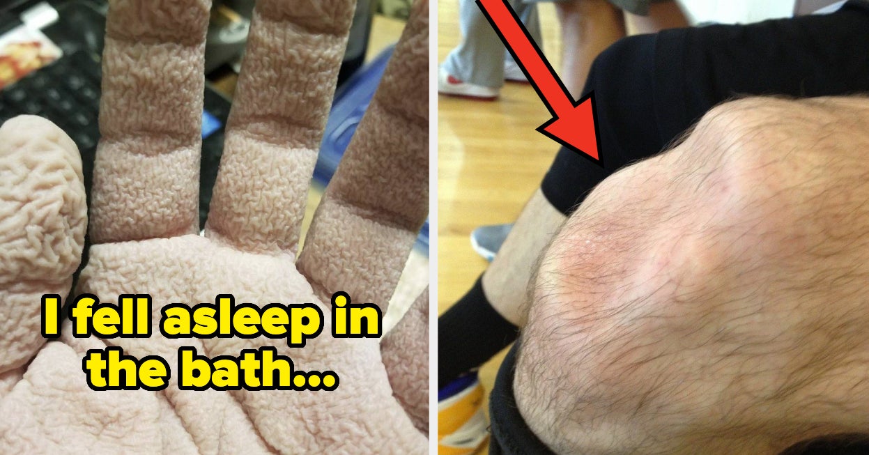 48 Absolutely Fascinating Photos Of Injuries Conditions And Disorders That Prove Humans Are Freaking Metal BuzzFeed 48 Absolutely Fascinating Photos Of Injuries Conditions And Disorders That Prove Humans Are Freaking Metal BuzzFeed