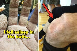 Left image shows a pruney hand with text "I fell asleep in the bath..." Right image shows a knee with an indent