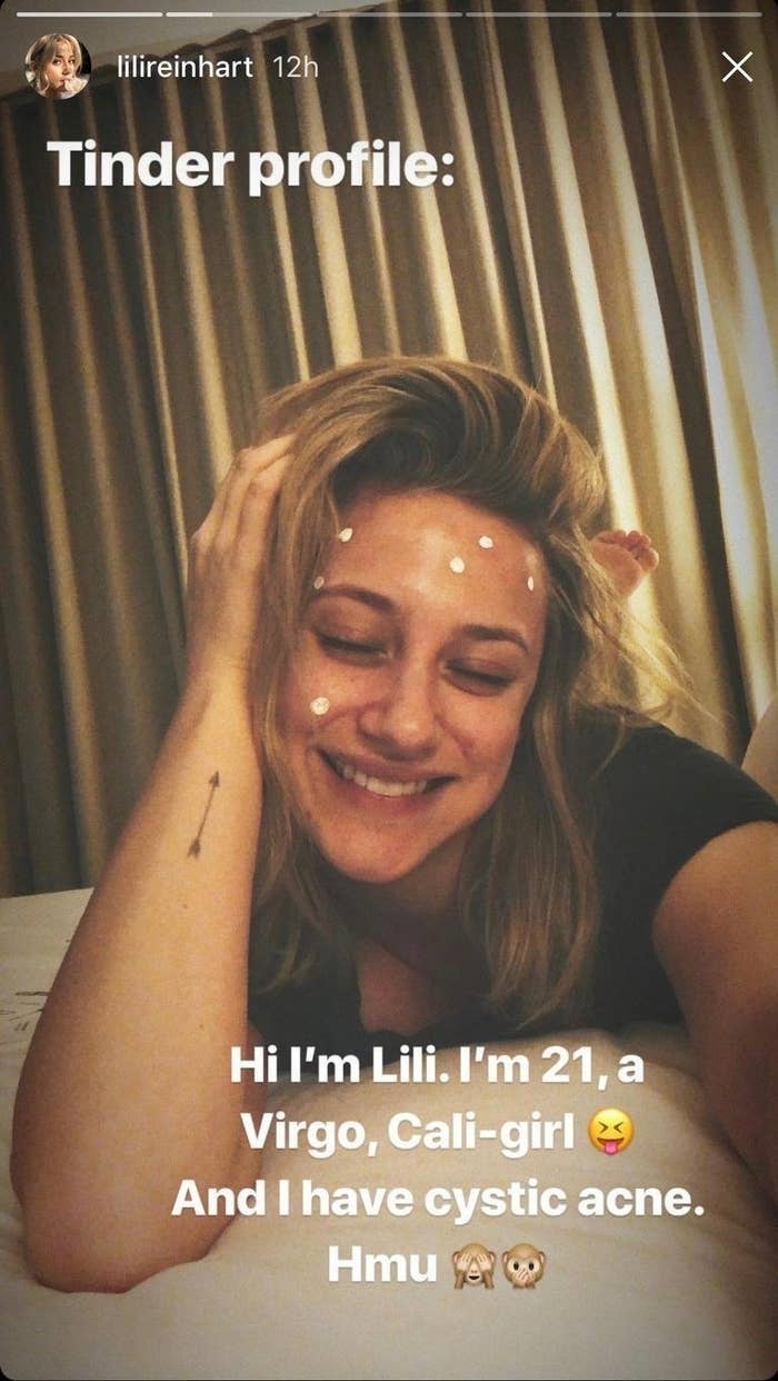 Person lying on a bed, smiling, with acne treatment dots on their face. Text reads: &quot;Hi I&#x27;m Lili. I&#x27;m 21, a Virgo, Cali-girl ? And I have cystic acne. Hmu ??&quot;