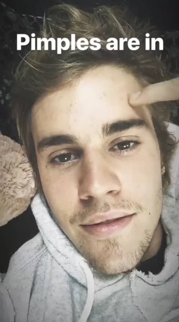 Person in a casual hoodie lying down, pointing at a small blemish on their forehead. Text says, &quot;Pimples are in.&quot;
