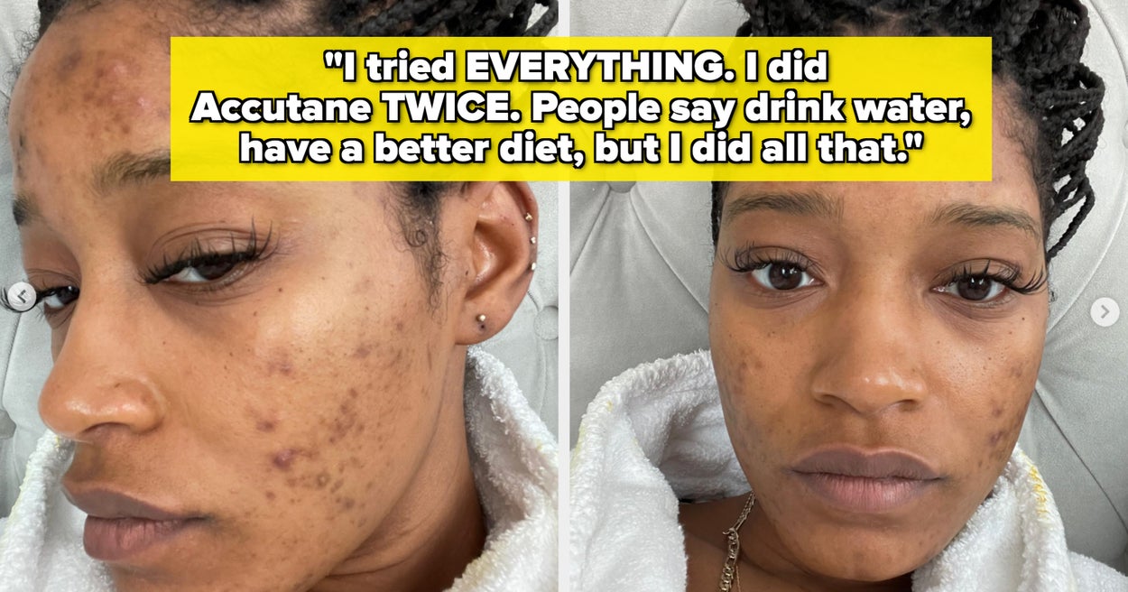 11 Celebrities Open Up About Acne Struggles