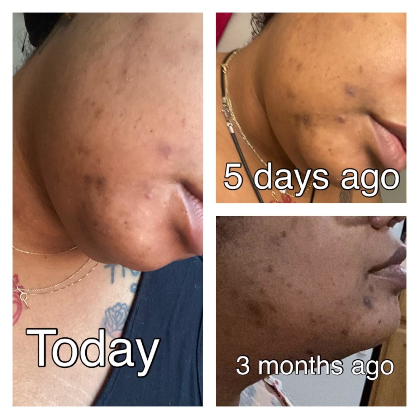 Skincare progress collage: side views of a person showing gradual improvement in complexion from three months ago to today
