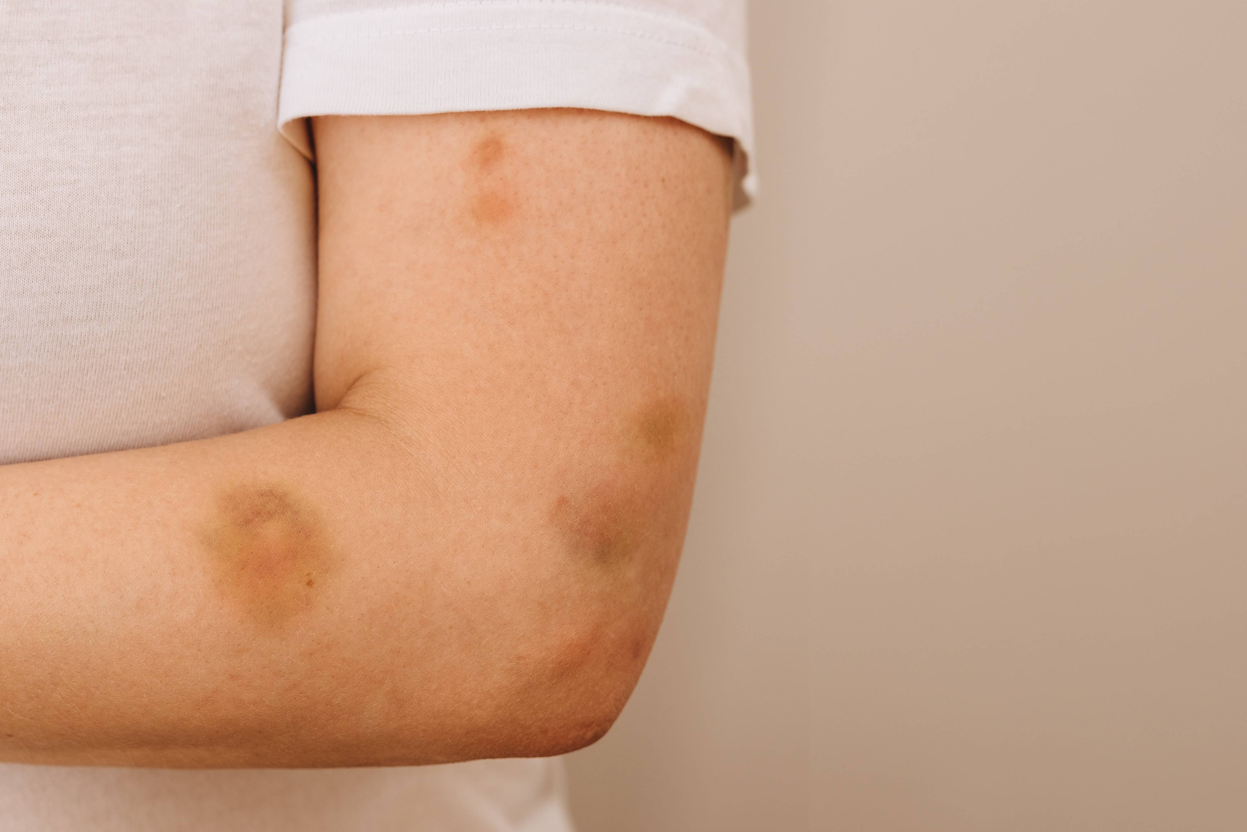 En persons arm med synlige blåmerker, iført en kort ermet skjorte