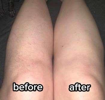 Close-up of 2  legs, 1  hairy and 1  smooth, suggesting hairsbreadth  removal results