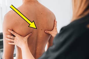 Person examining a mole on another person's back, with a large yellow arrow pointing at the mole. Skin health check in a medical setting
