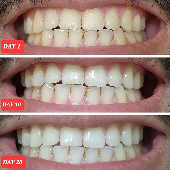 Three close-up images amusement teeth whitening progression from Day 1 to Day 20, highlighting visibly whiter teeth implicit time