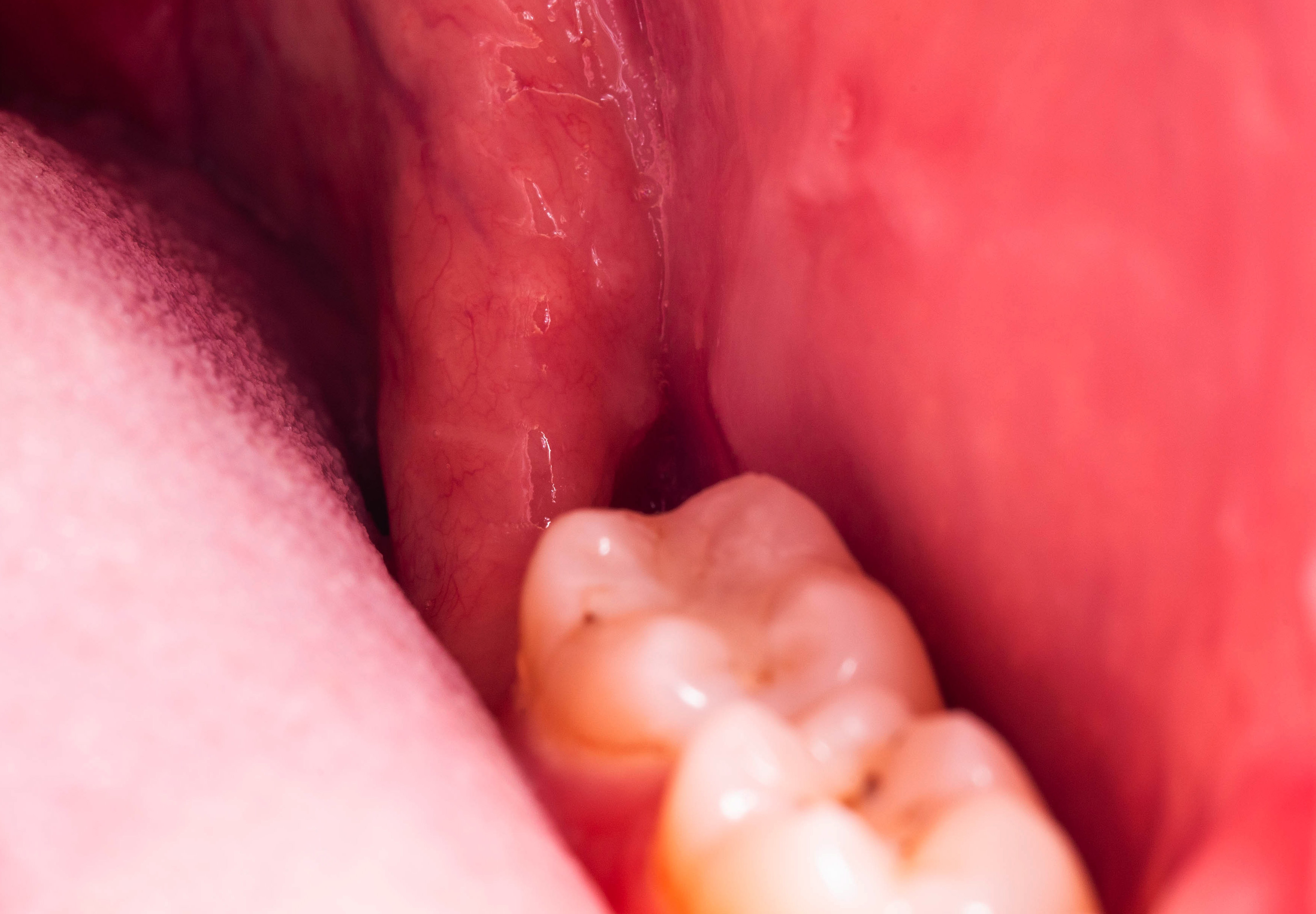 Nærbilde av en persons munn som viser en molar tann og omgivende tannkjøtt