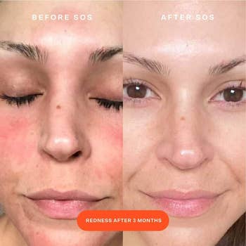 Split representation showing facial tegument betterment earlier and aft utilizing a skincare product, labeled