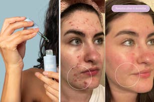 Woman applying skincare serum; before-and-after photos show improved skin with reduced acne after 6 months