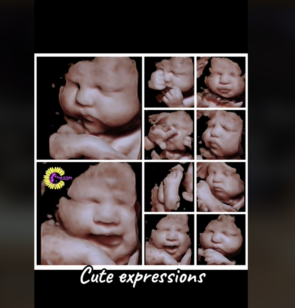 Laughing During Pregnancy TikTok Ultrasound