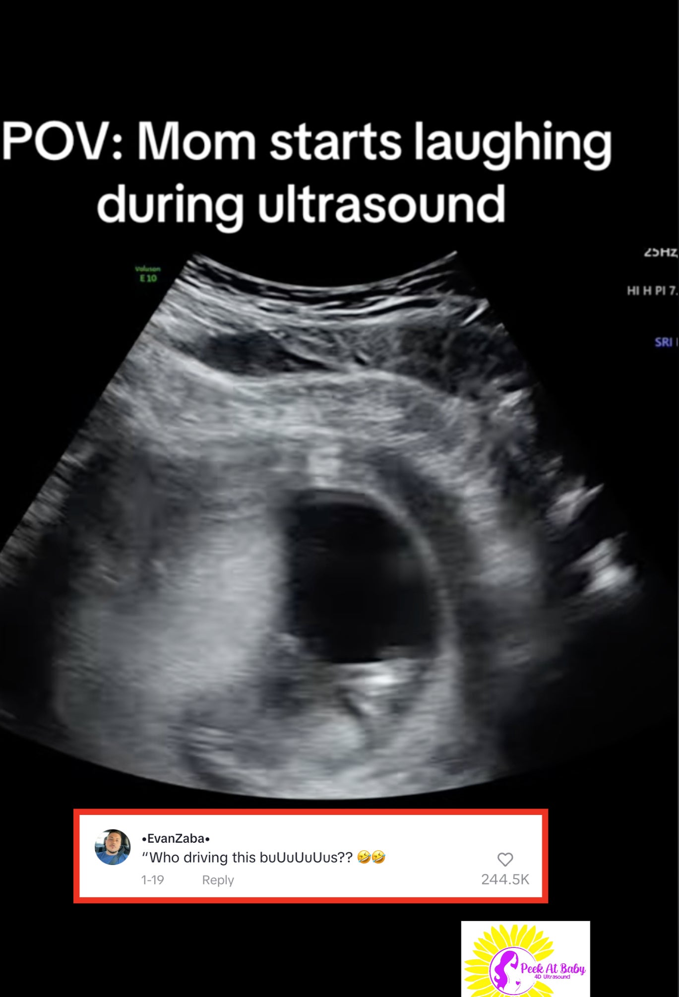 Laughing During Pregnancy TikTok Ultrasound