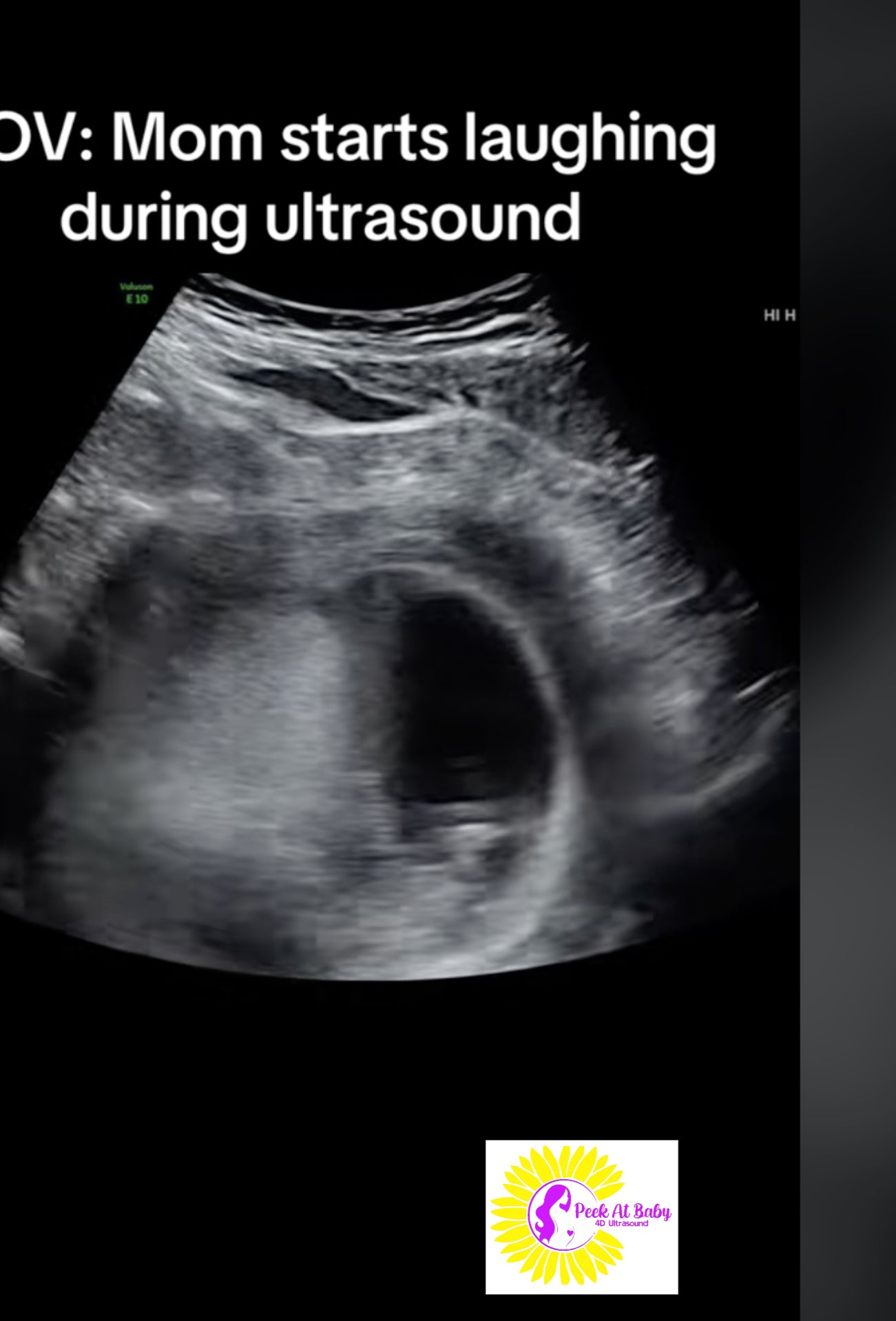 Laughing During Pregnancy TikTok Ultrasound