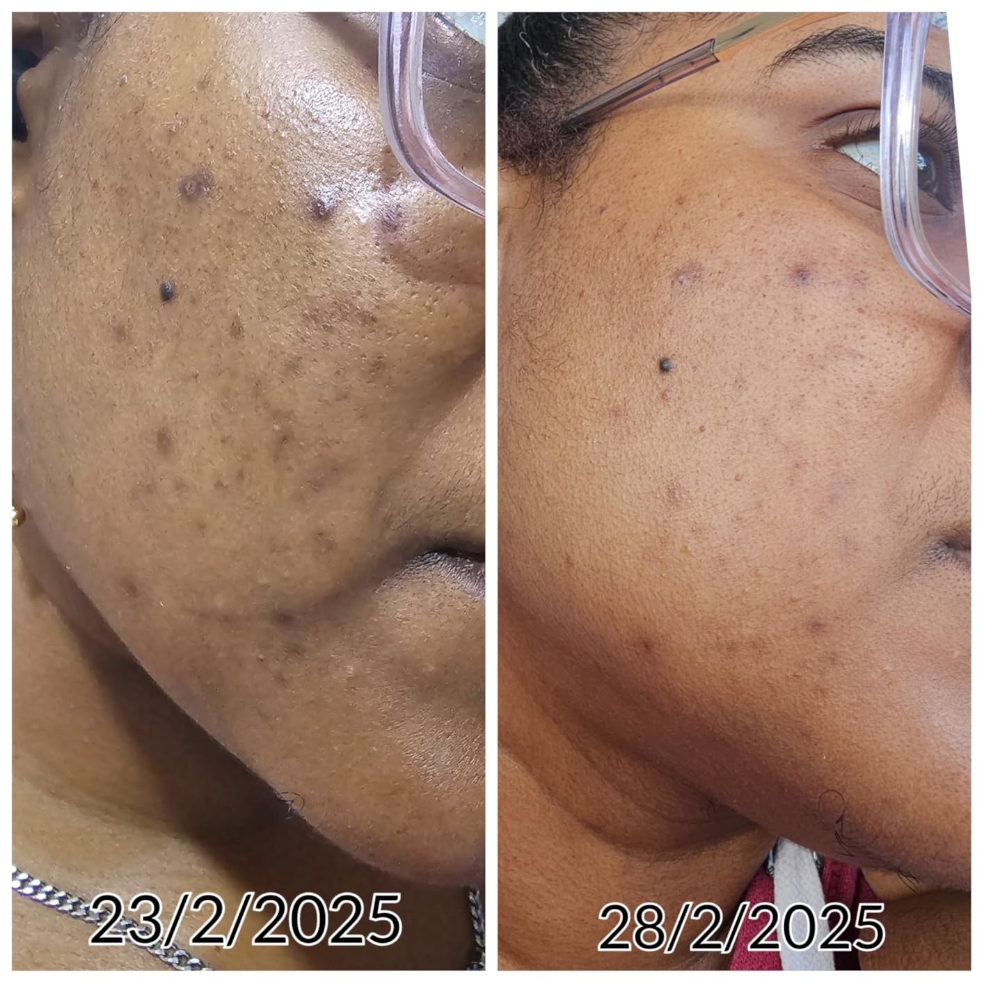 Side-by-side comparison of a reviewer's cheek showing skin improvement over five days, dated 23/2/2025 and 28/2/2025