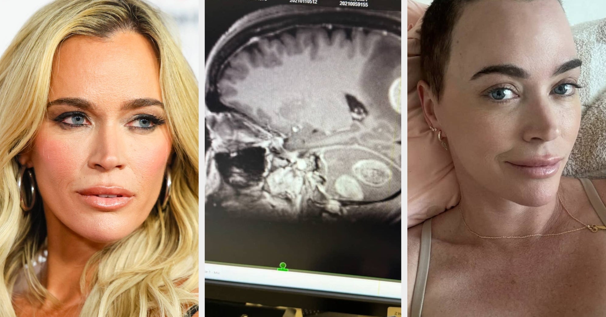 Bintang “Real Housewives” Teddi Mellencamp mengungkapkan dia telah didiagnosis dengan lebih banyak tumor otak dan masih menjalani perawatan