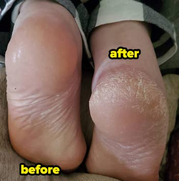 Before and aft  examination  of feet, showing creaseless  tegument  versus dry, cracked tegument  connected  heels