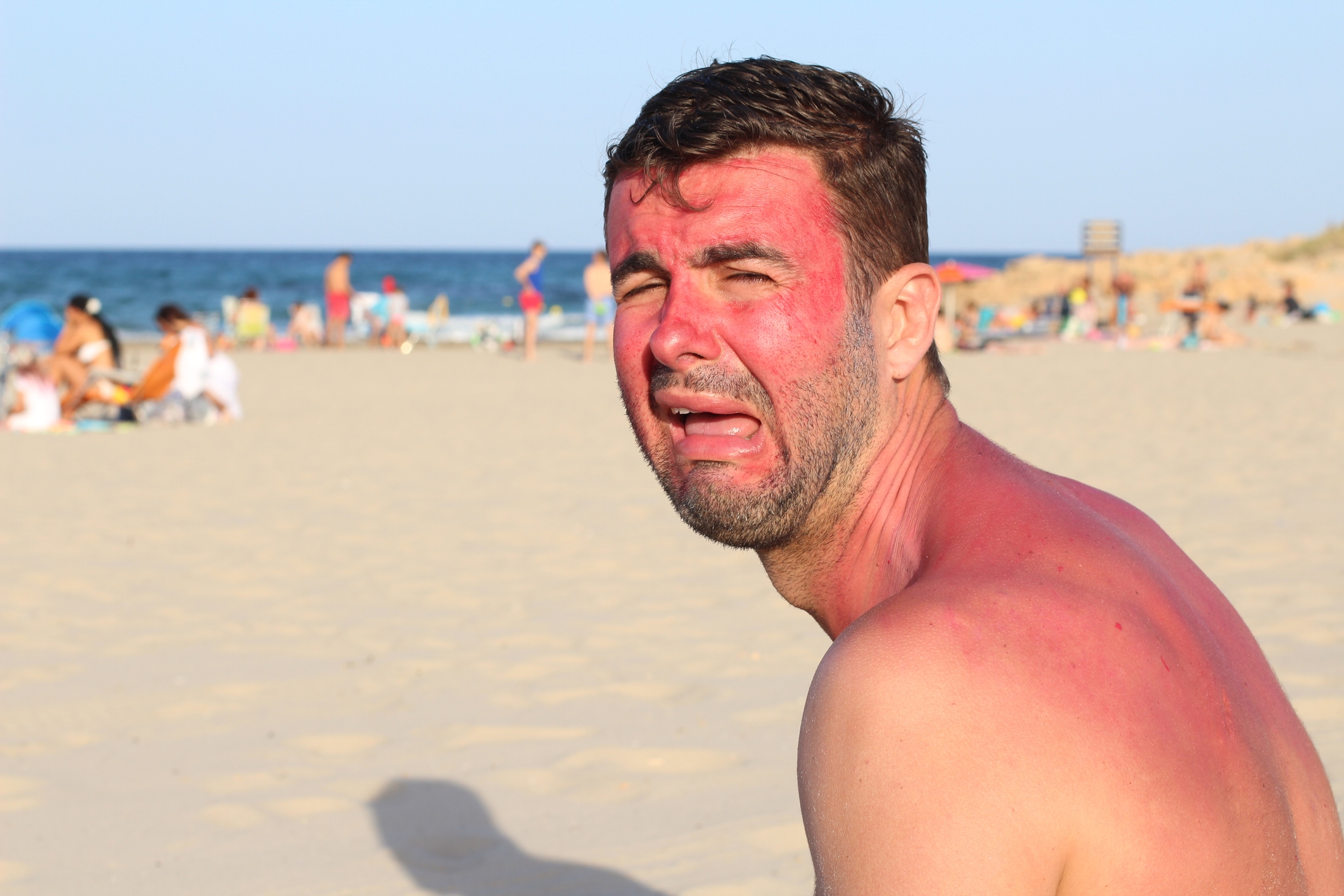 Mann på stranden med alvorlig solbrenthet som ser ukomfortabelt ut