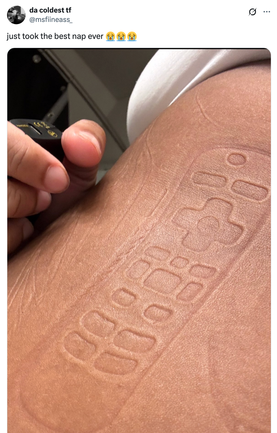 Imprint of a TV remote on a person's skin after a nap, with a caption expressing amusement