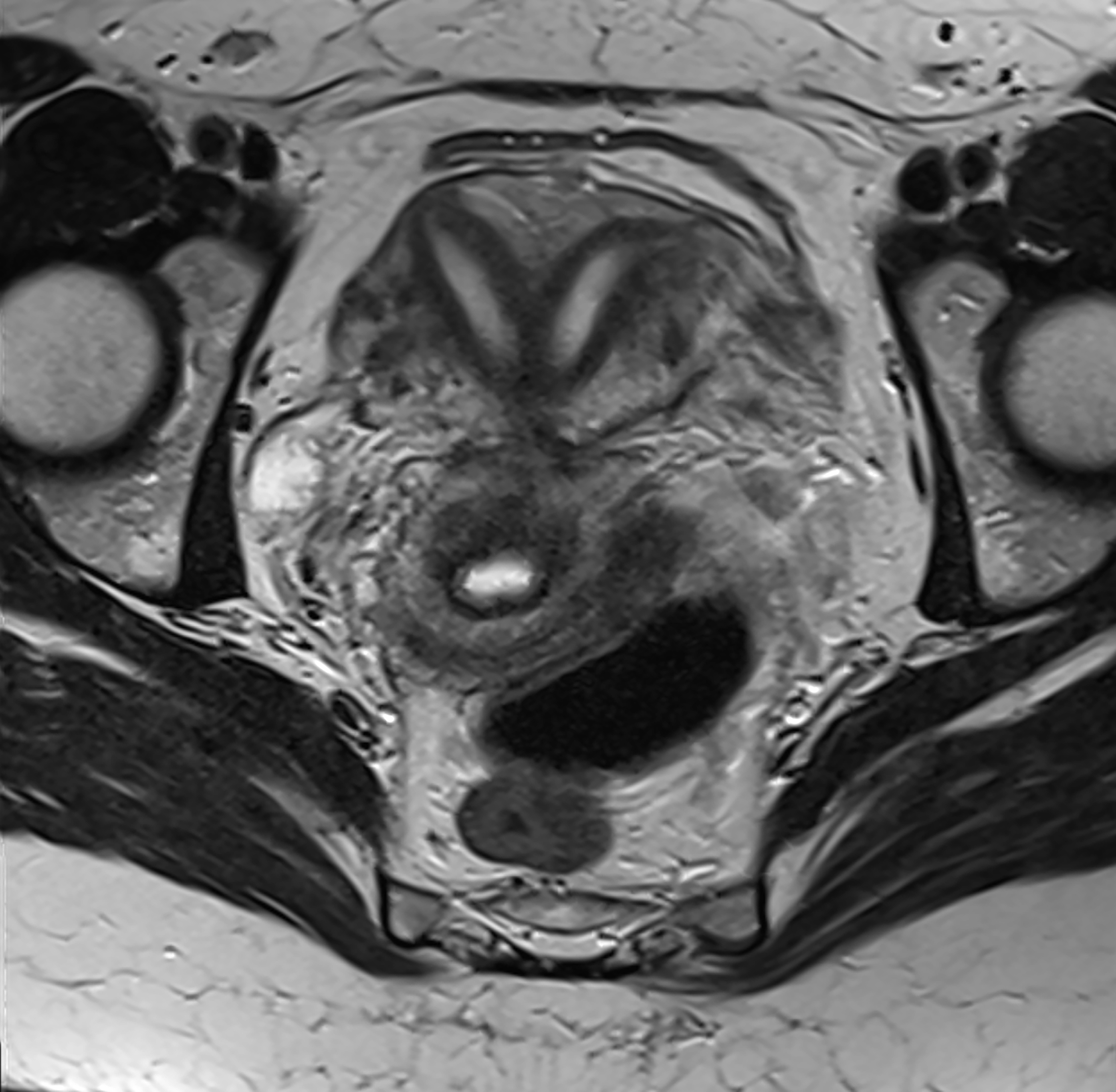 MRI scan showing an axial view of the pelvic region with visible bones and organs