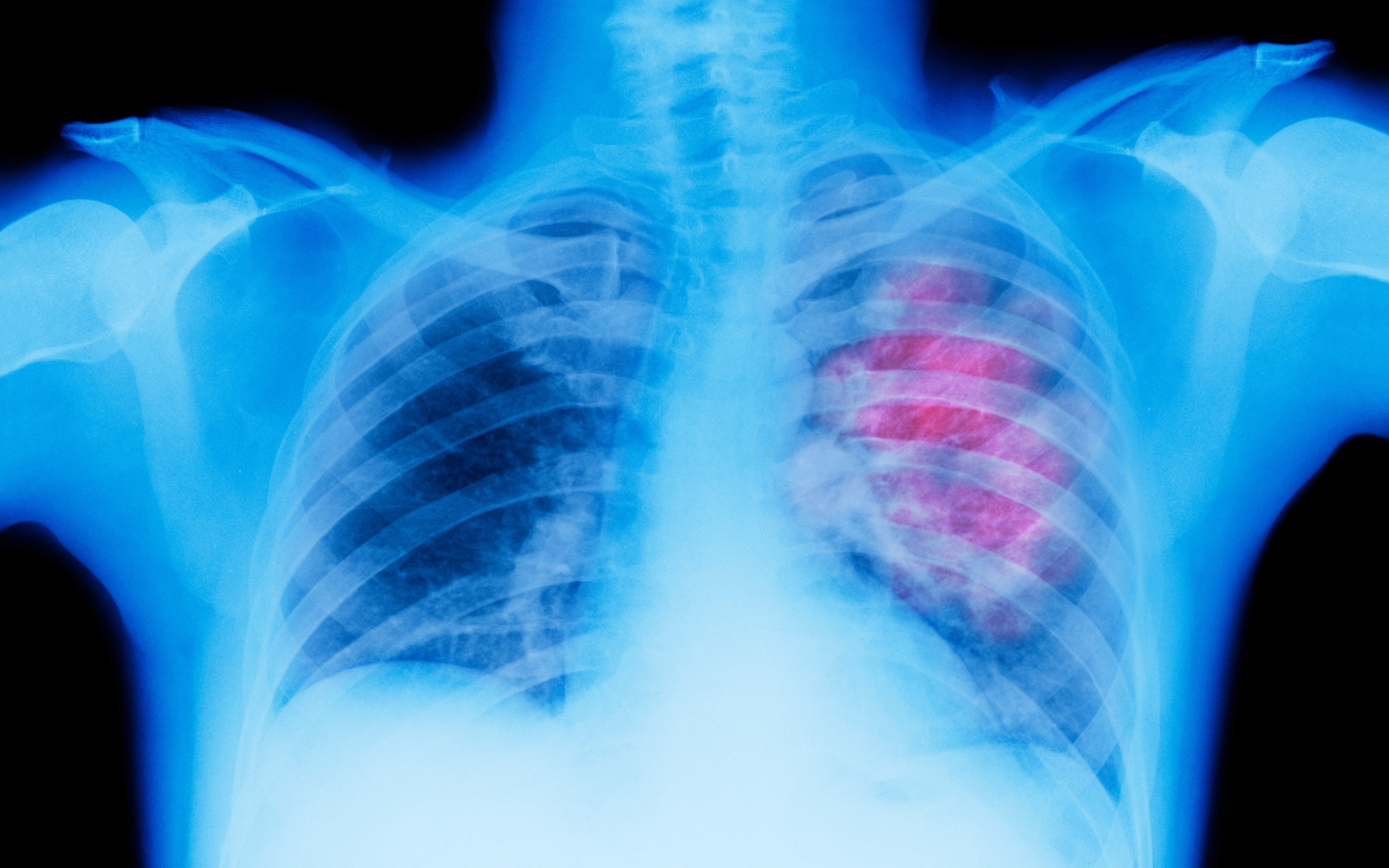 X-ray of a human chest showing the lungs, with a highlighted area indicating a possible medical concern on one side
