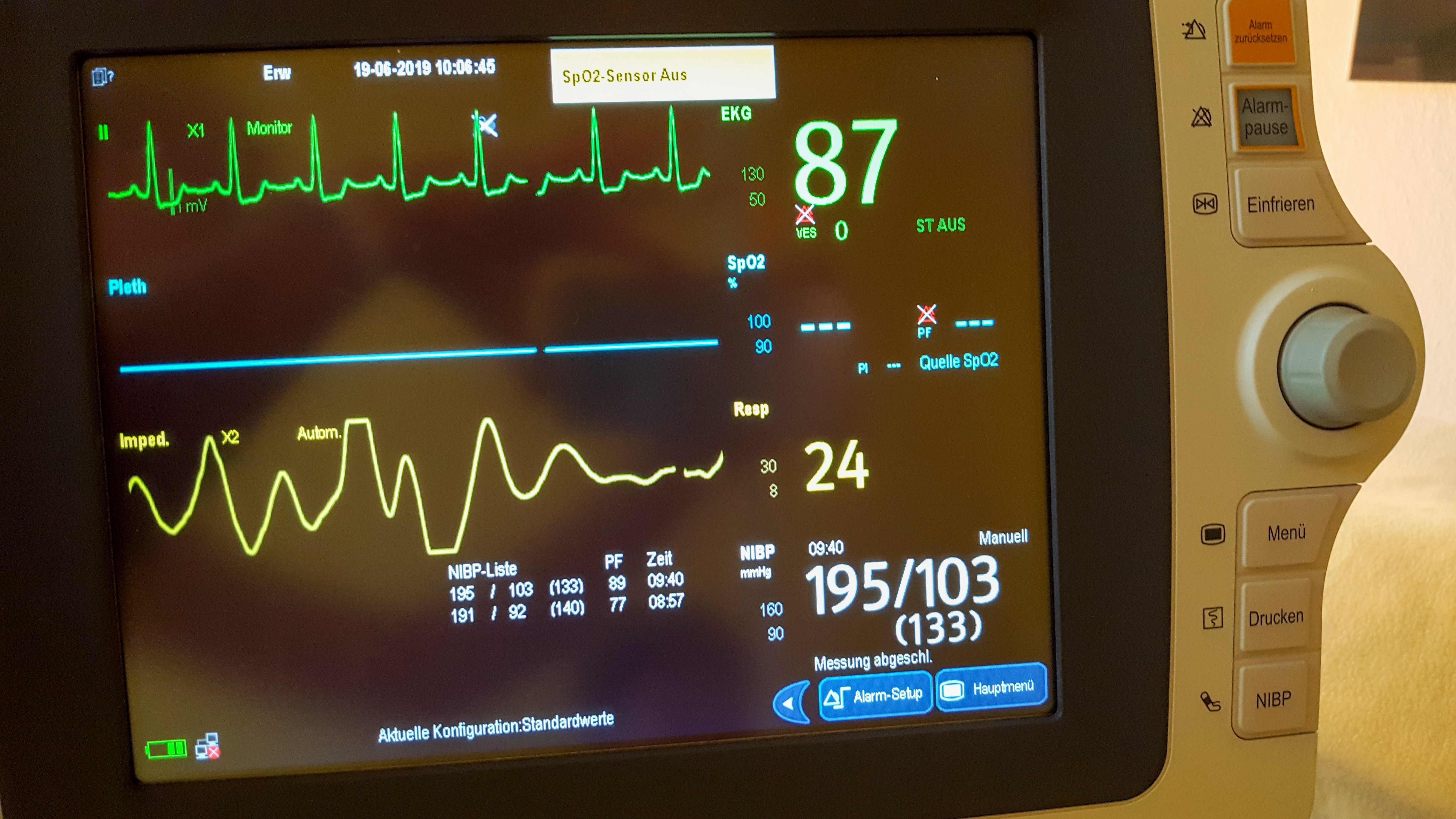 Medical monitor displaying heart rate, oxygen saturation (SpO2), and blood pressure readings, indicating patient’s vital signs in a clinical setting