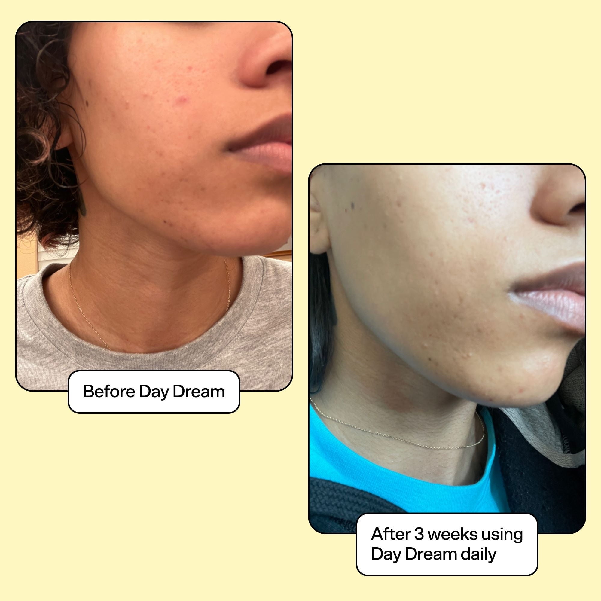 Before and aft  photos showing tegument  betterment  with Day Dream product; disposable   simplification  successful  blemishes aft  3 weeks of regular  use