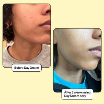 Before and aft photos showing tegument betterment with Day Dream product; disposable simplification successful blemishes aft 3 weeks of regular use