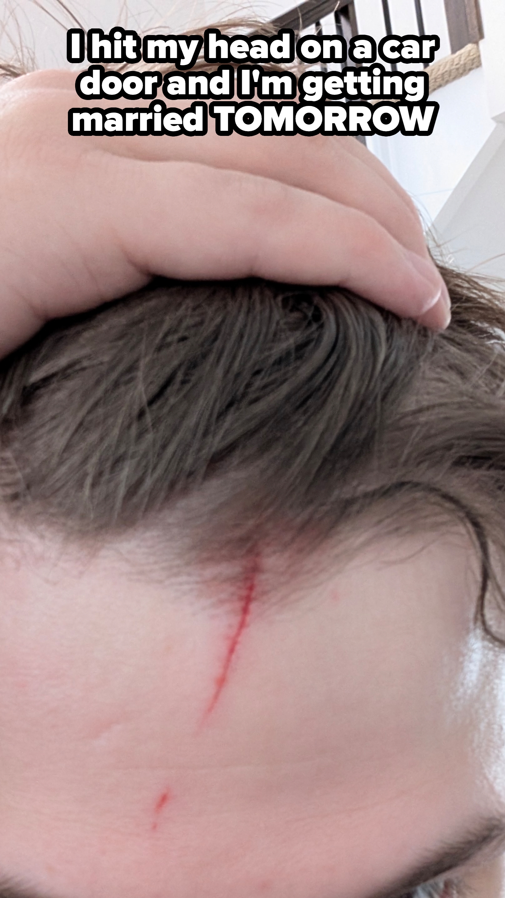 Person showing a fresh cut on their forehead while holding their hair back