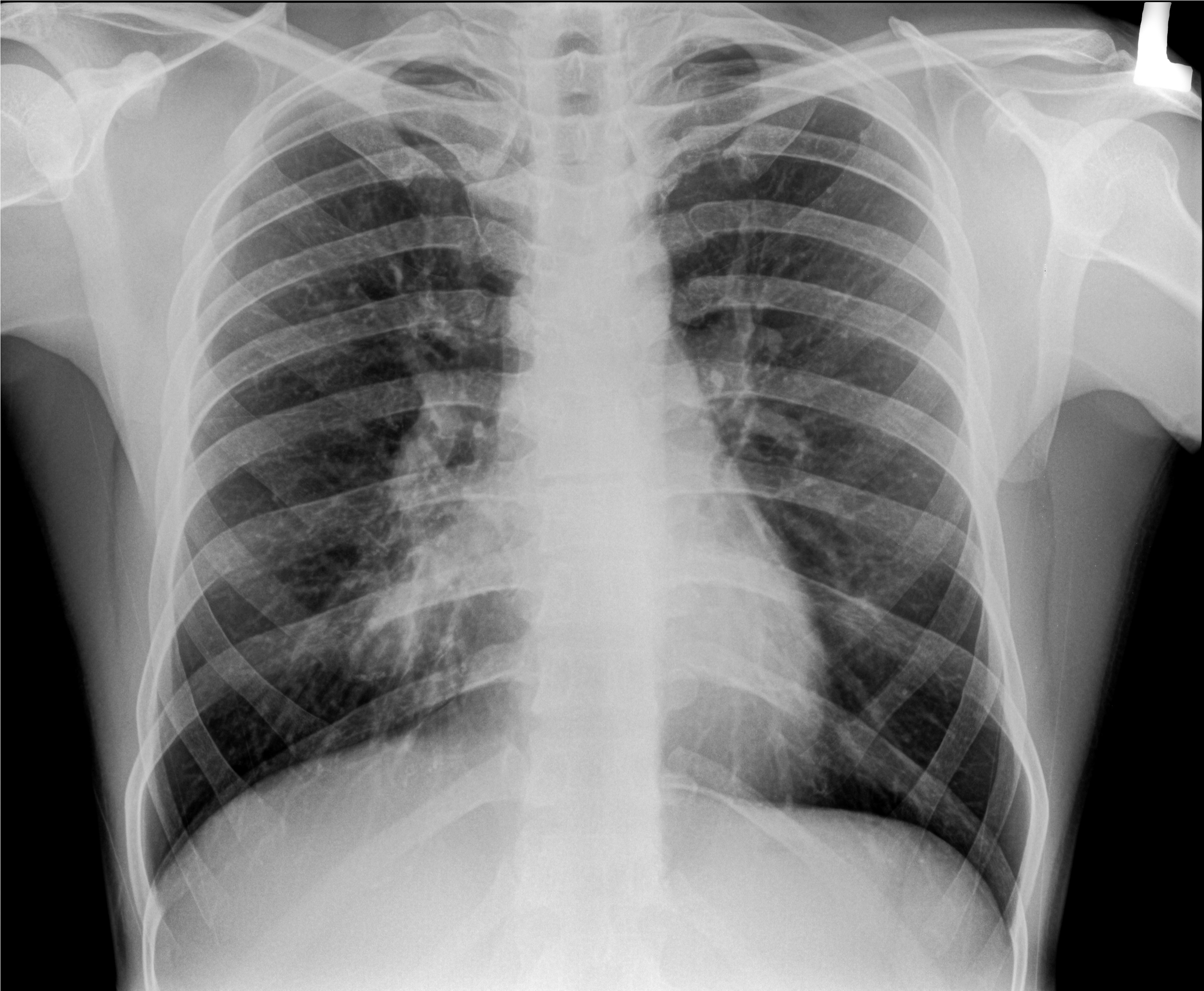 X-ray image of a human chest, showing ribcage, spine, and lungs with visible internal features for medical analysis