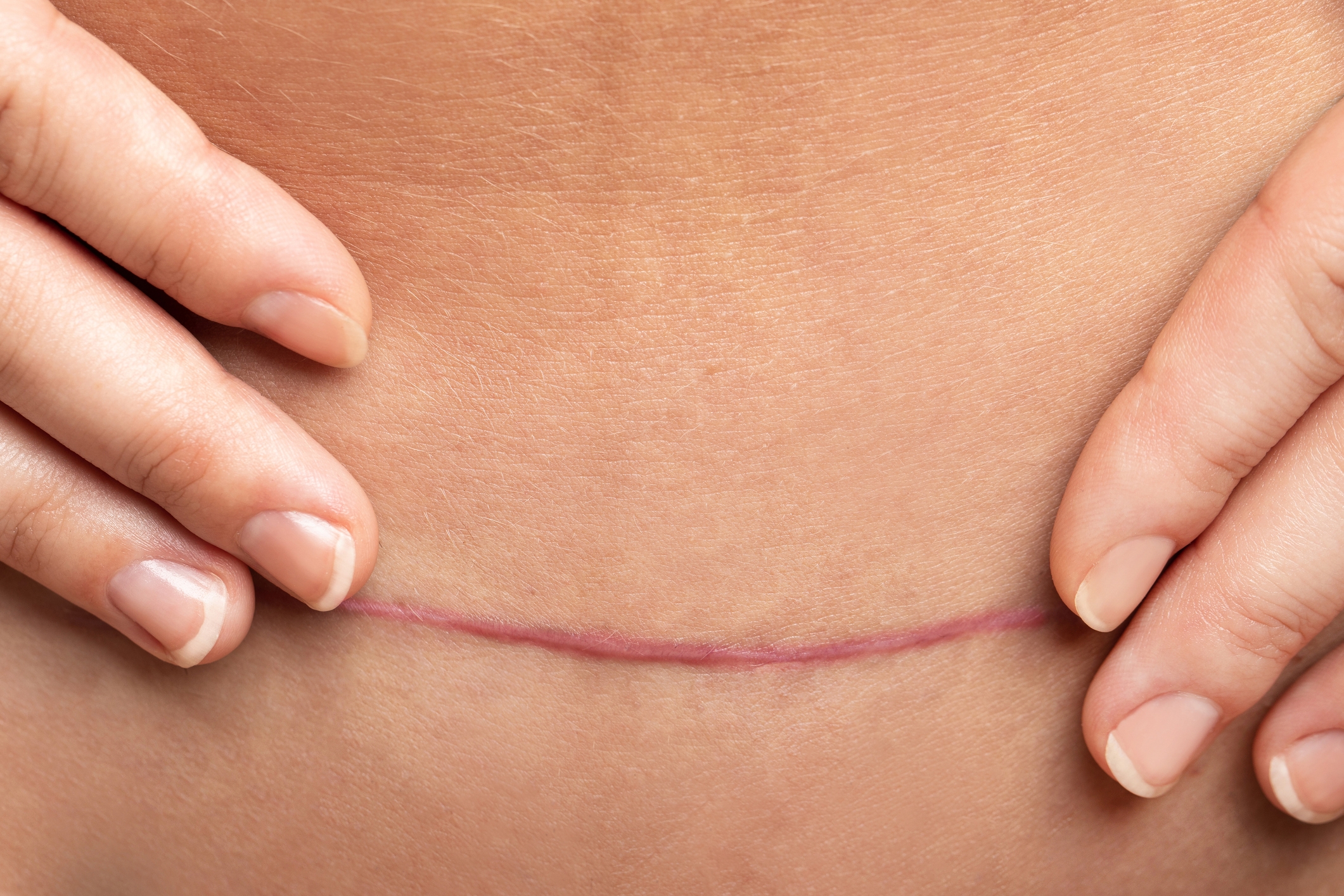 Hands gently hold the skin on either side of a horizontal surgical scar on the abdomen