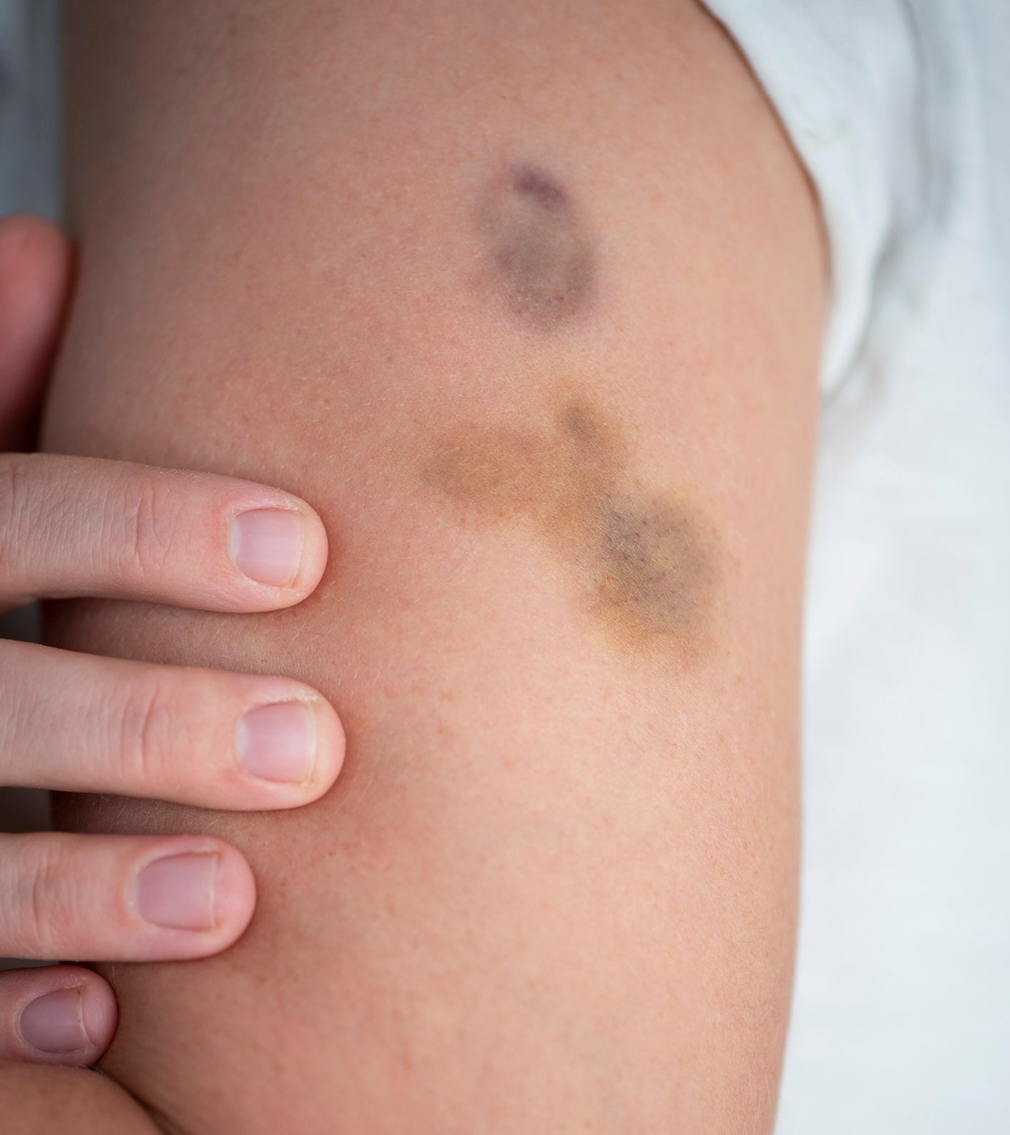 Bruised upper arm with three dark patches, a hand gently touching the arm