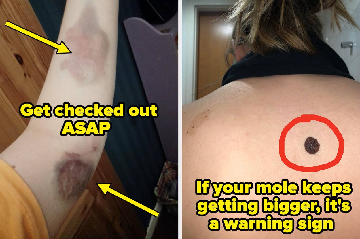 Left image shows bruises on an arm with text urging a check-up; Right image shows a person's back with a circled mole and warning about changes in size