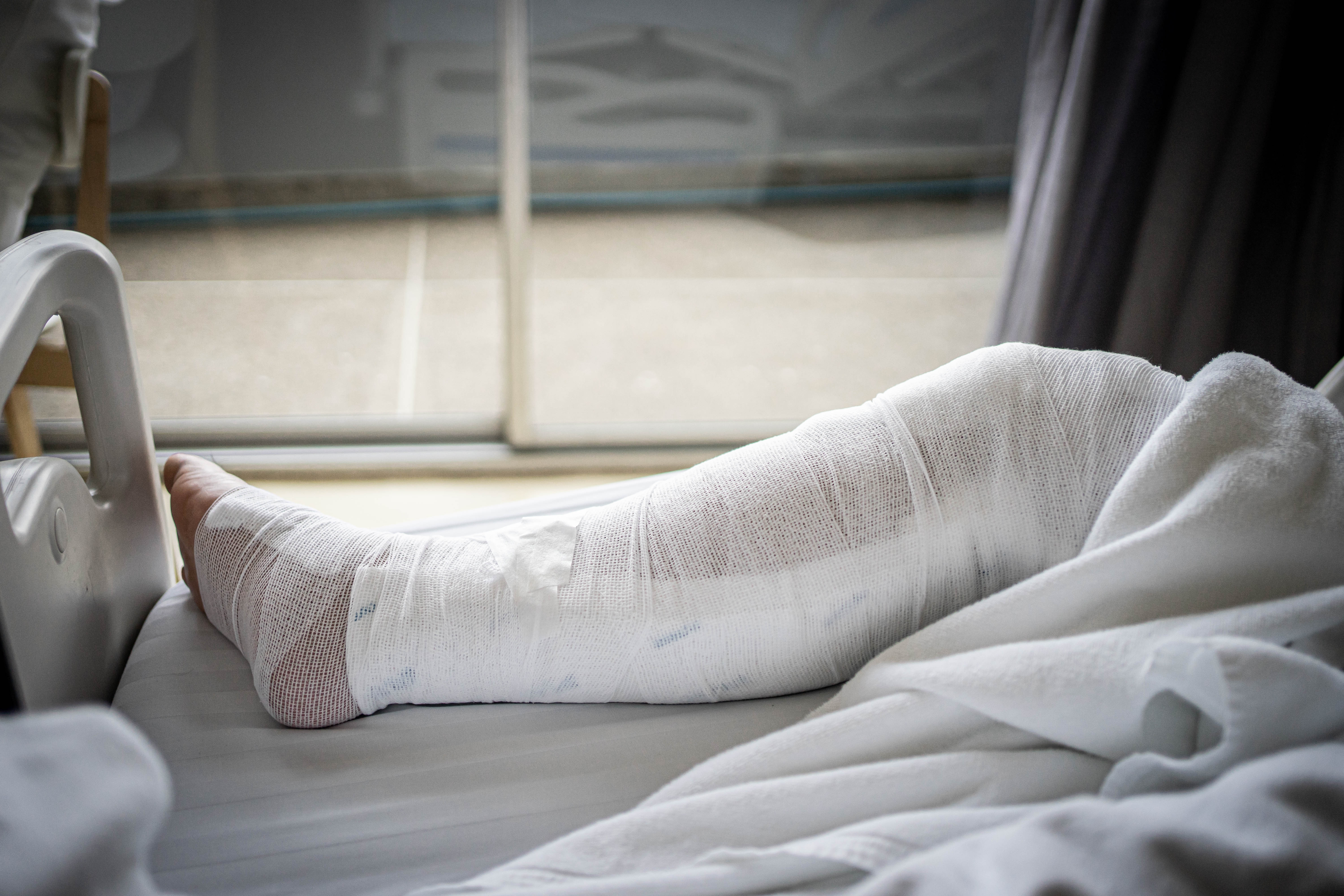 A leg in a hospital bed is wrapped in a thick cast, elevated slightly, highlighting a medical situation or recovery process