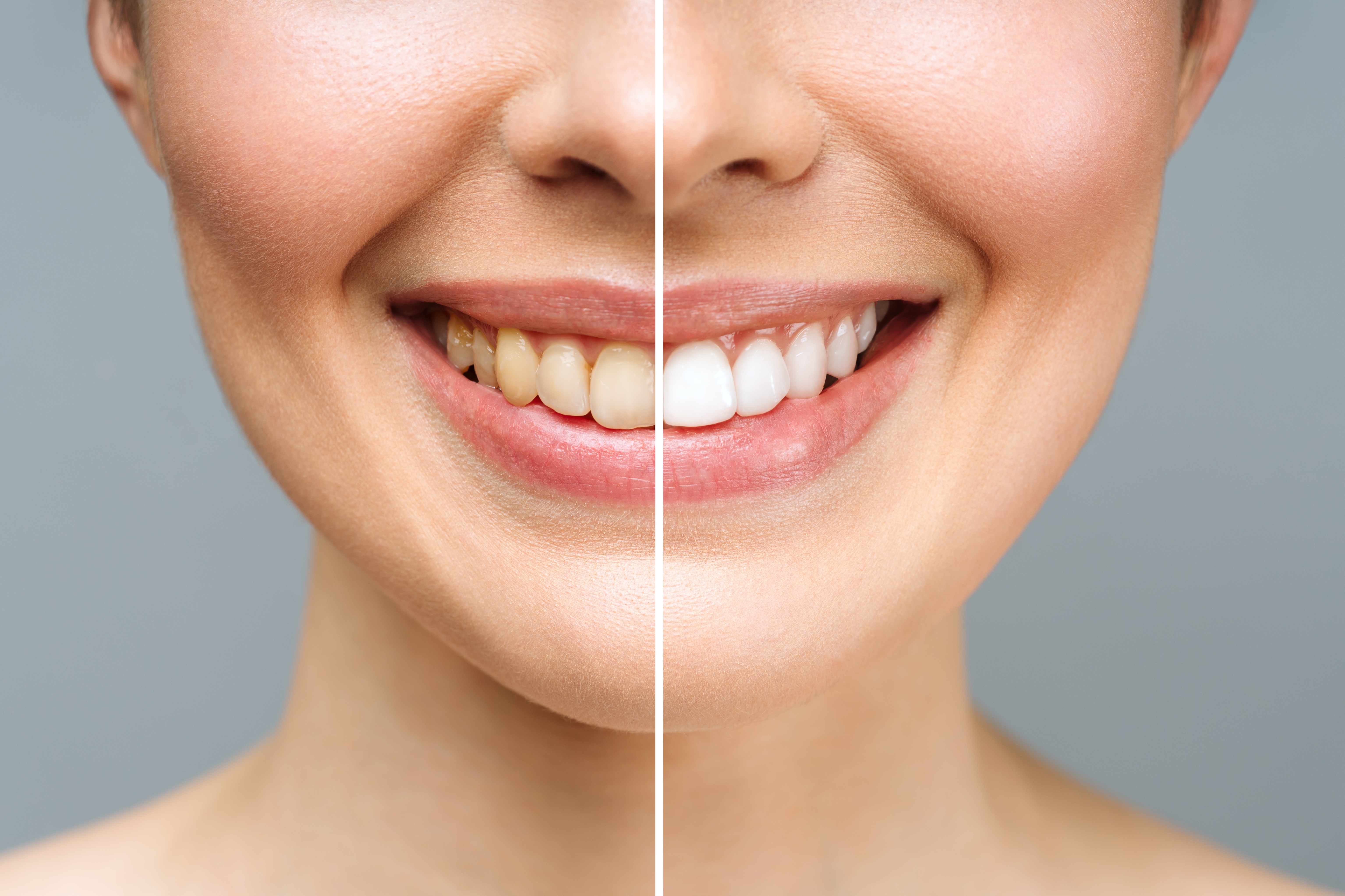 Close-up of a split image showing teeth before and after whitening, highlighting the transformation in dental appearance