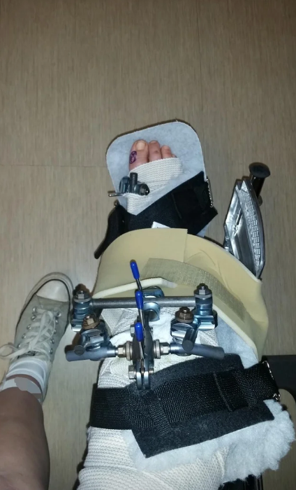 Person's leg in a brace with external fixation