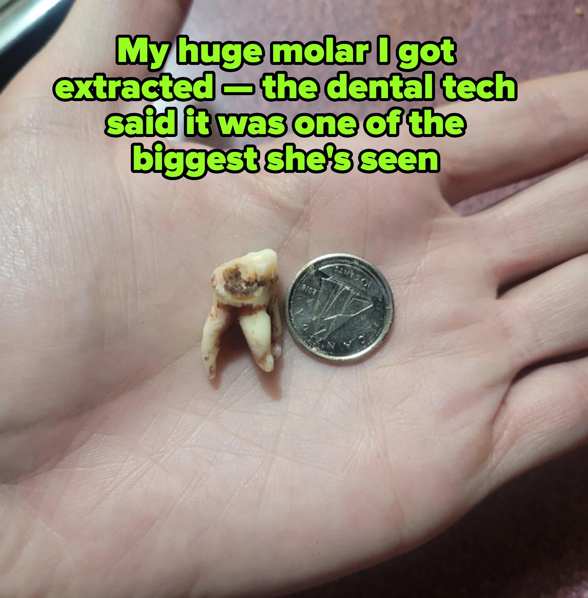 A hand holds a large damaged tooth with three long roots. Caption: "My huge molar I got extracted — the dental tech said it was one of the biggest she's seen"