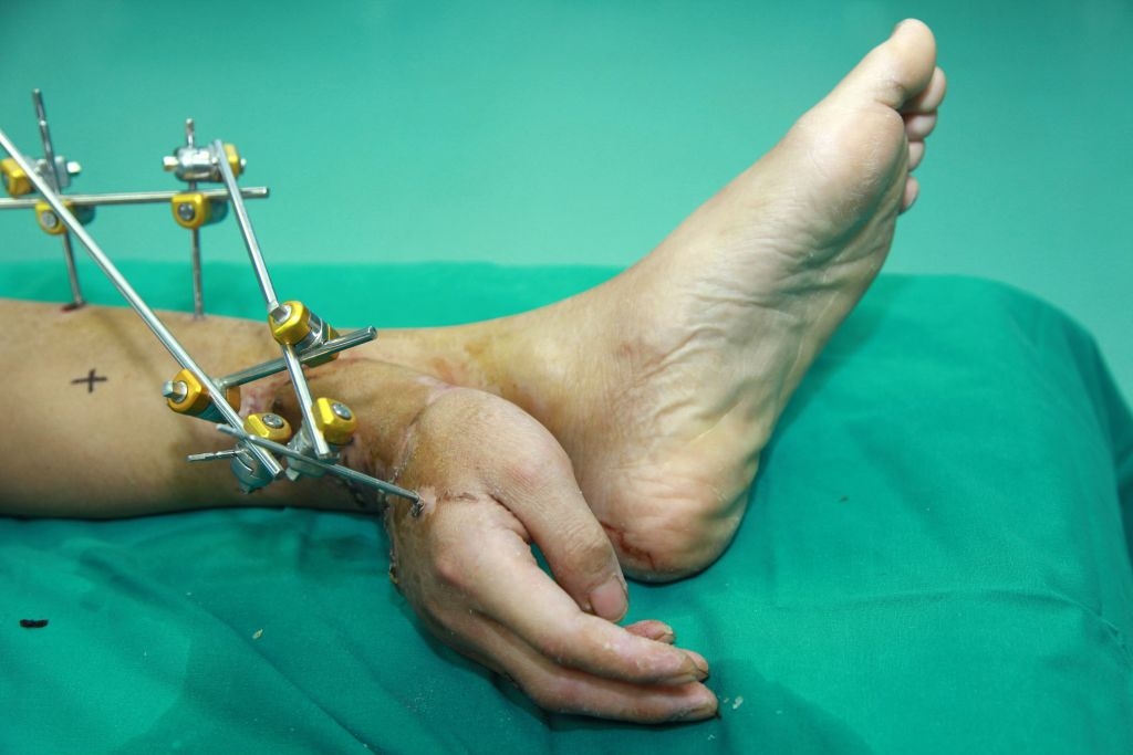 A surgical procedure where a hand is temporarily attached to an ankle, with metal fixators holding the position